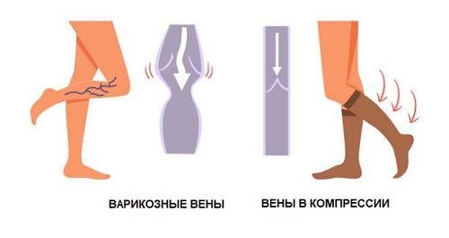 Компресійні панчохи