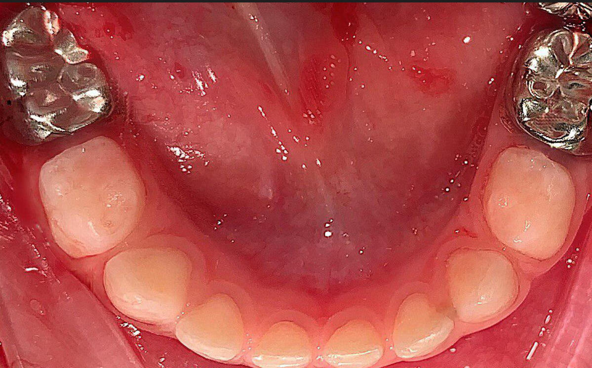 дитяча коронка