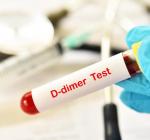 Анализ крови на D-димер