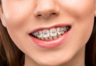 встановлення брекетів у FrankoLab Clinic