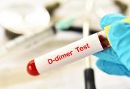 Анализ крови на D-димер
