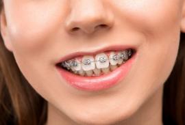 встановлення брекетів у FrankoLab Clinic