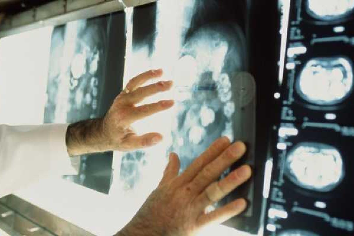 Месячник по борьбе с туберкулезом стартовал в Луганске