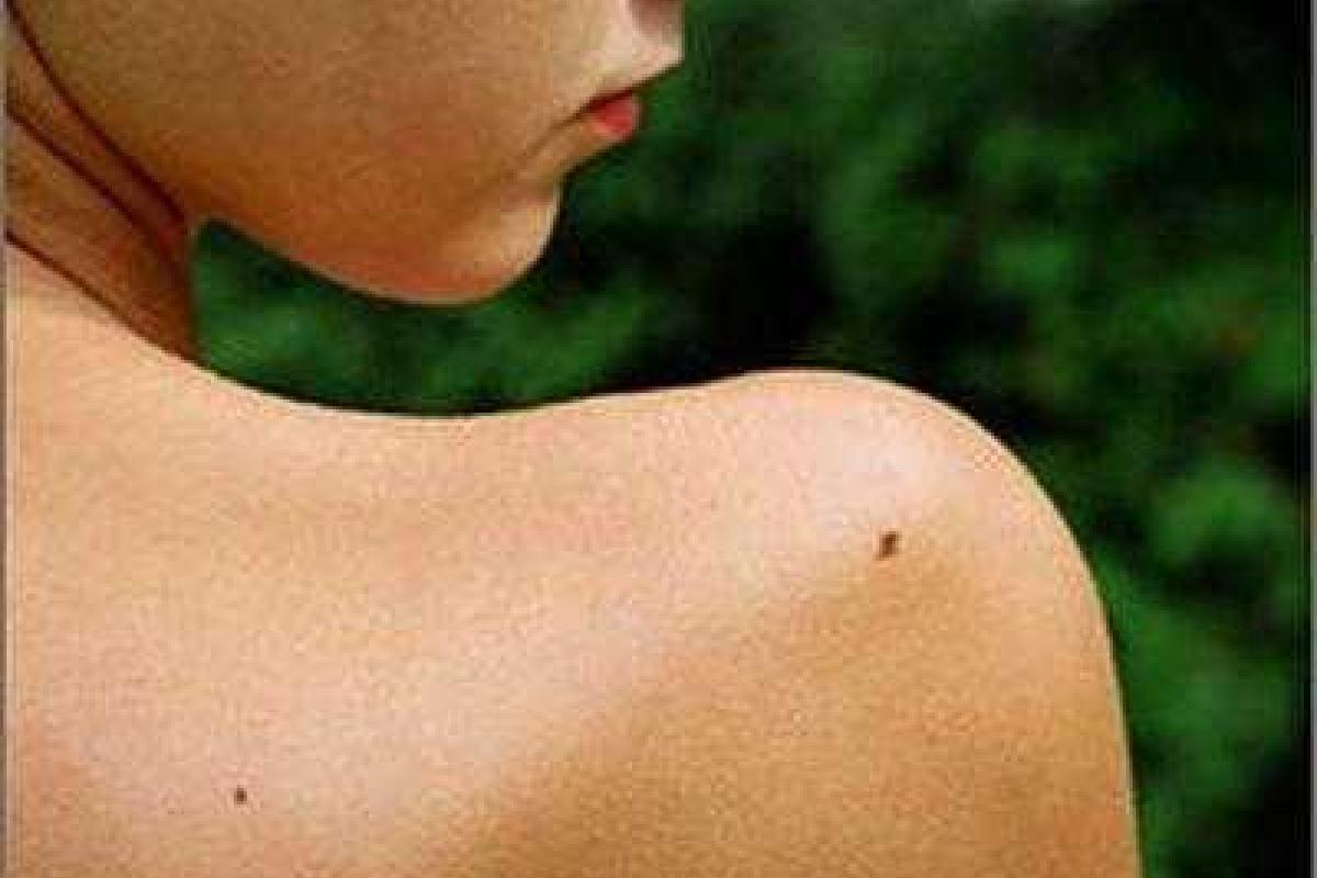 Медики: Родинки могут быть предвестником рака молочной железы