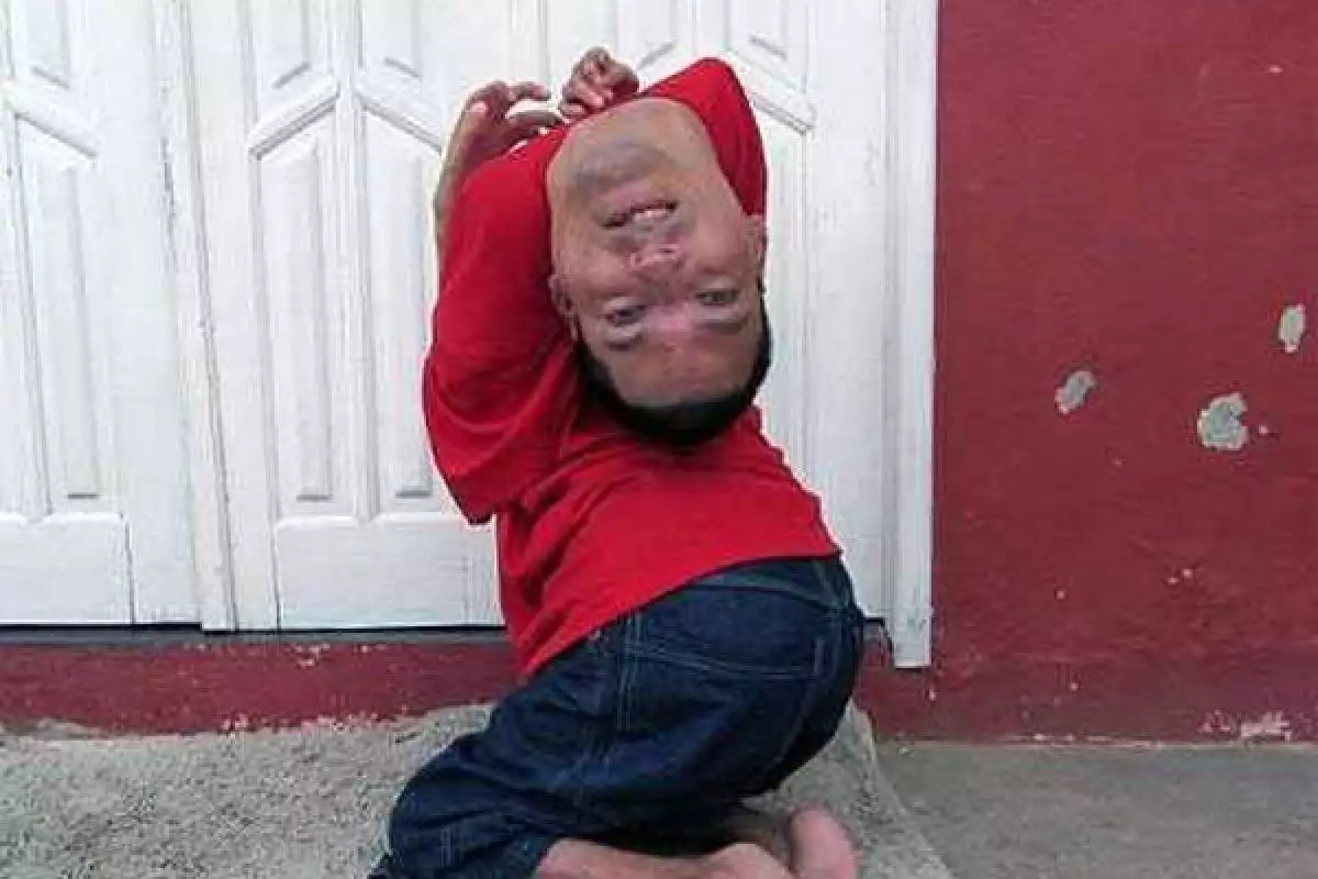 Мужчина, родившийся с перевернутой головой, выжил несмотря на прогнозы врачей