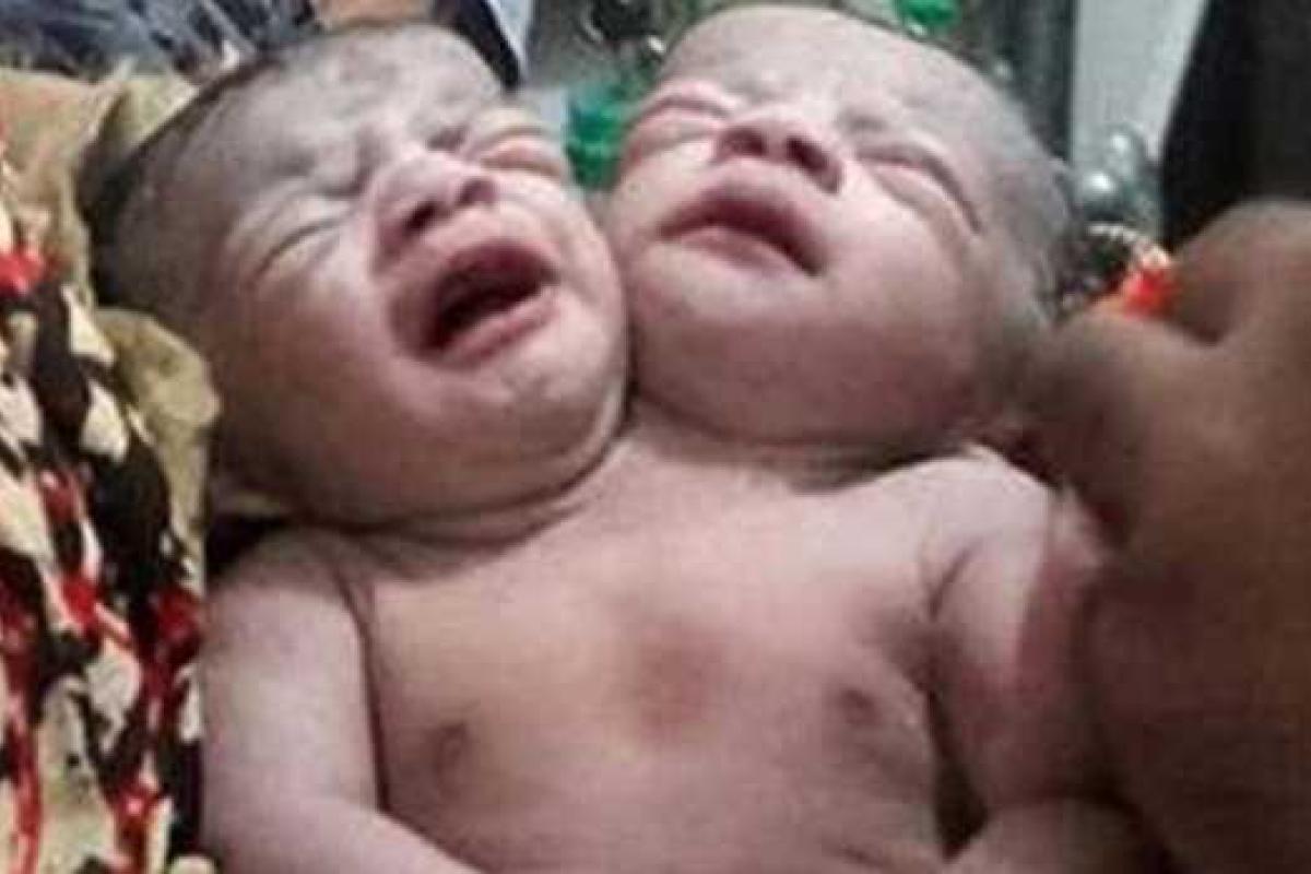 Ребенок с двумя головами появился на свет в Бангладеш