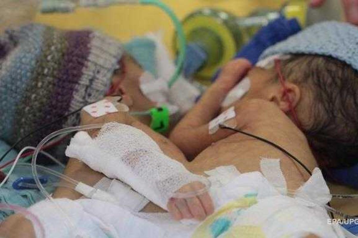 Блестящую операцию по разделению сиамских близнецов провели в швейцарском госпитале