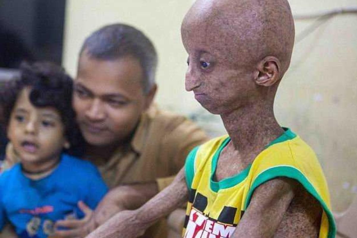 В Индии живет подросток, похожий на инопланетянина