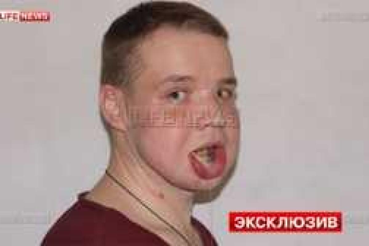 В России хирурги провели уникальную операцию: мужчине, потерявшему челюсть в схватке с медведем, поставили протез В России хирурги провели уникальную операцию: мужчине, потерявшему челюсть в схватке с медведем, поставили протез
