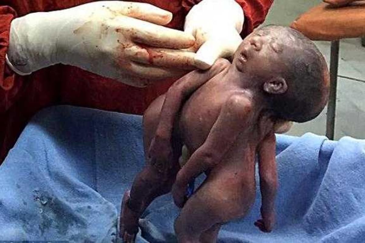 В Индии на свет появились сиамские близнецы с одной головой