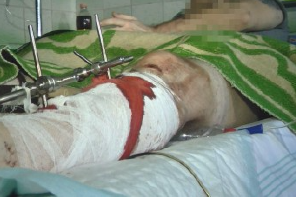 Байкер, пострадавший в Харькове 9 мая, рассказал подробности нападения Байкер, пострадавший в Харькове 9 мая, рассказал подробности нападения