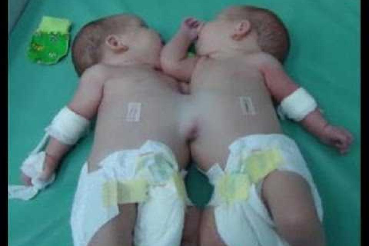 В Москве продолжается операция по разделению девочек-сиамских близнецов В Москве продолжается операция по разделению девочек-сиамских близнецов