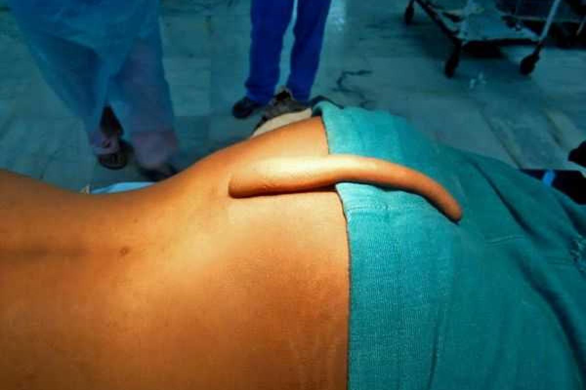 В Индии медики удалили парню 18-сантиметровый хвост В Индии медики удалили парню 18-сантиметровый хвост