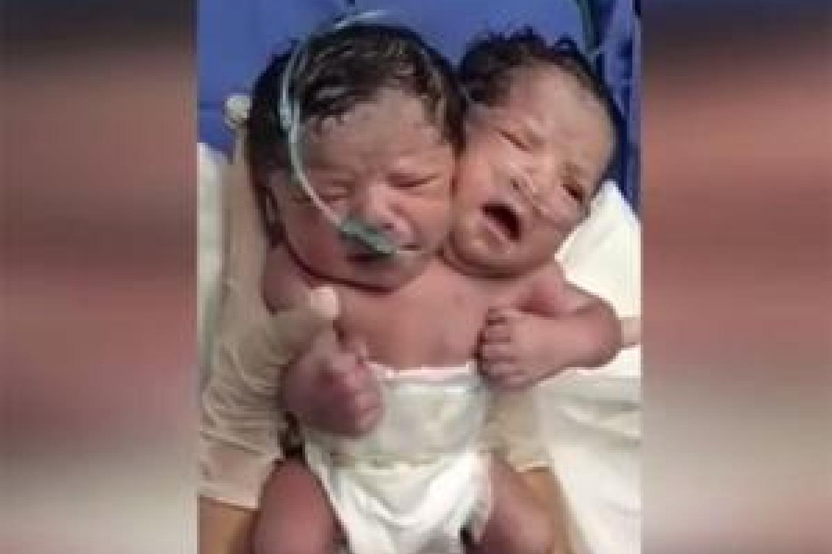 В Мексике на свет появился двухголовый младенец В Мексике на свет появился двухголовый младенец