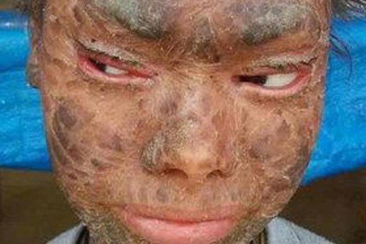 В Индии живет "девочка-змея", страдающая редким генетическим заболеванием