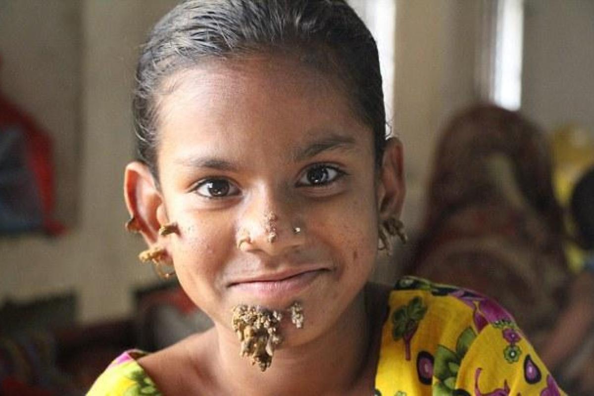 В Бангладеш у 10-летней девочки обнаружили синдром "человека-дерева"