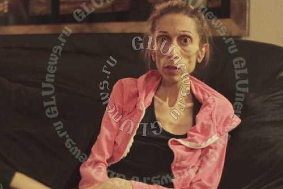 Умирающую от анорексии женщину отказываются лечить из-за худобы