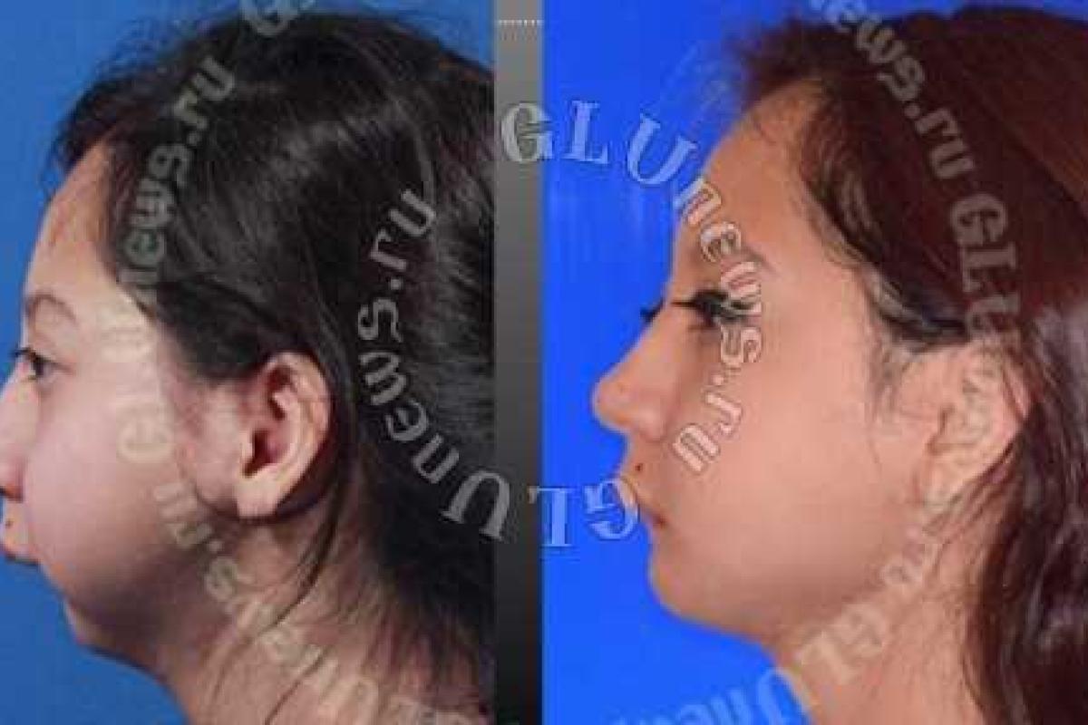 В Японии пластические хирурги помогли лишенной челюсти девушке