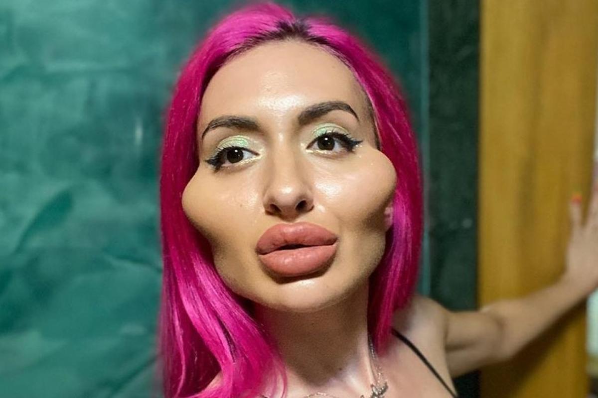 Українка з найбільшим вилицями в світі показала, як виглядала в 16 років - до пластики (фото)