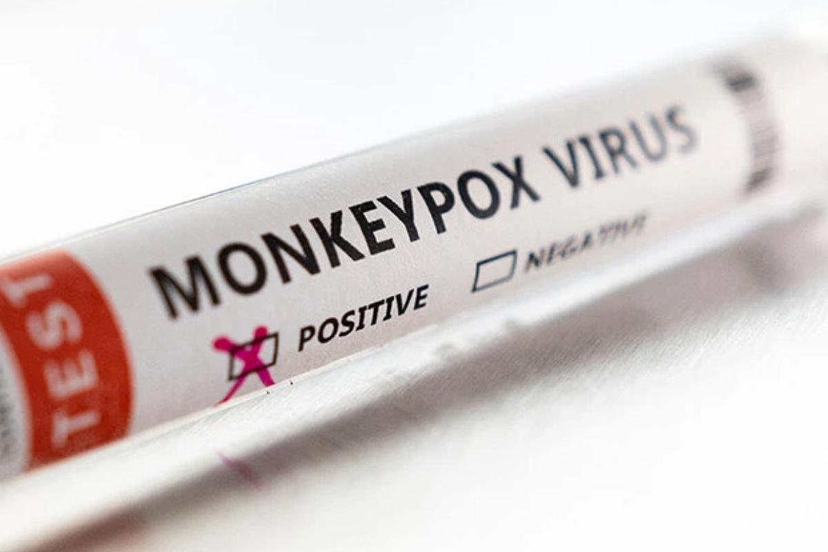 У Грузії виявили перший випадок зараження віспою мавп У Грузії виявили перший випадок зараження віспою мавп