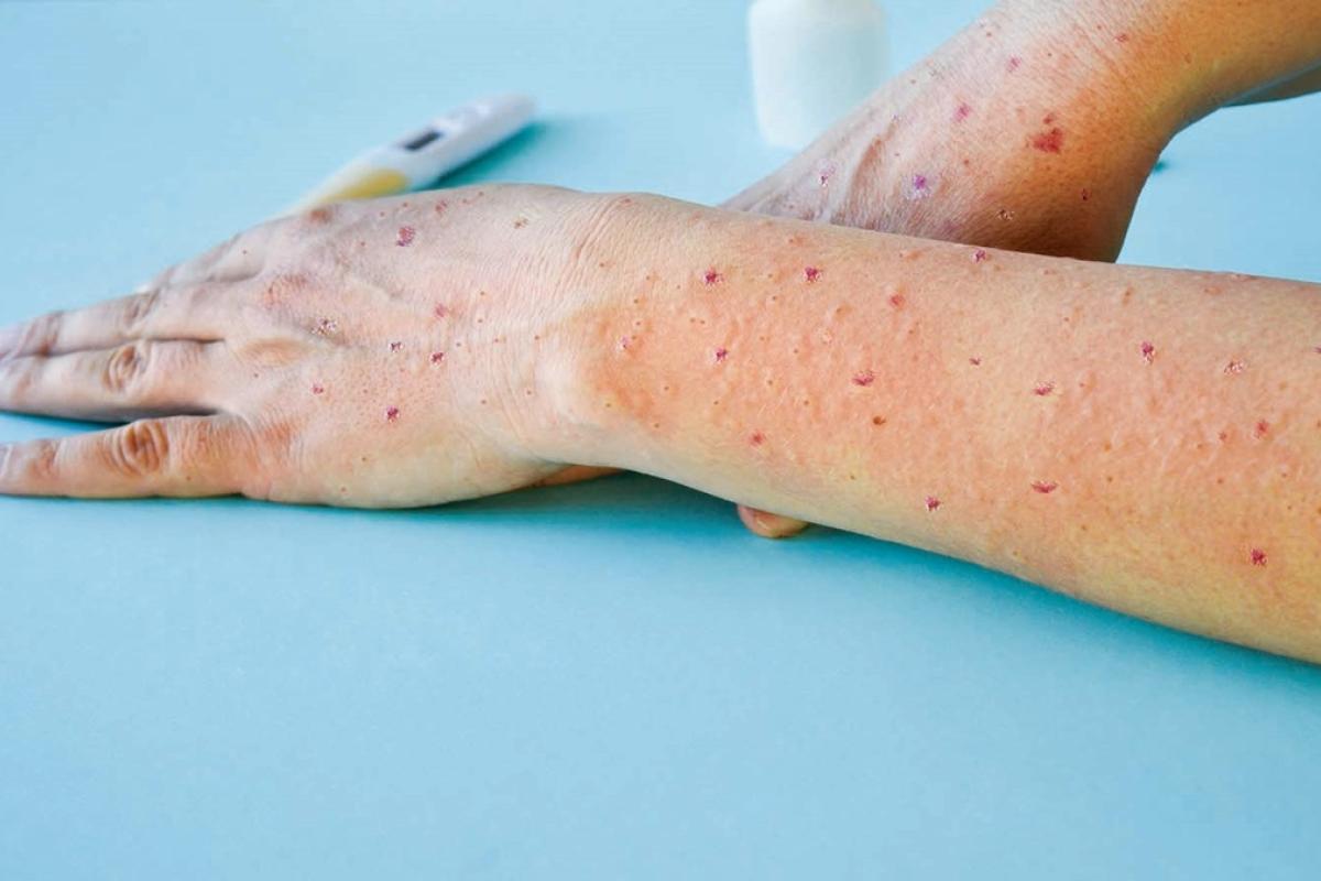 В Индии распространяется новый опасный вирус В Индии распространяется новый опасный вирус