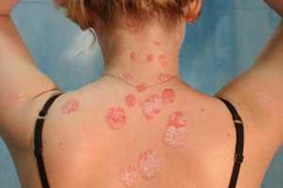 Симптомы псориаза и методы лечения