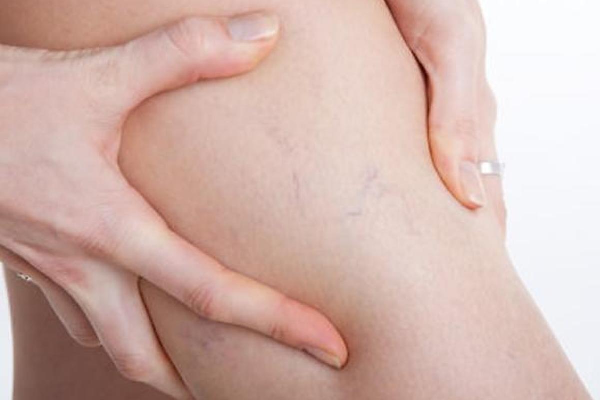 Как избавиться от варикоза ног