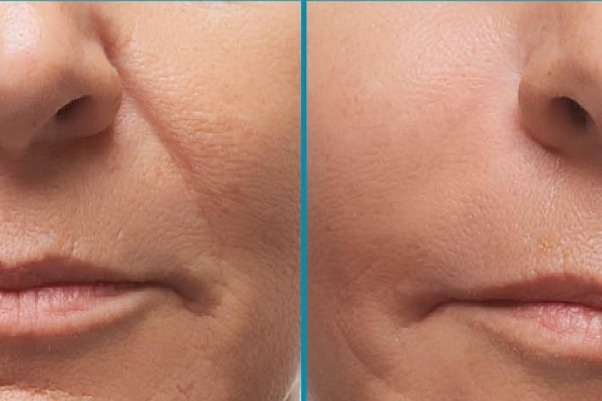 Какие филлеры подходят для носогубных складок Какие филлеры подходят для носогубных складок