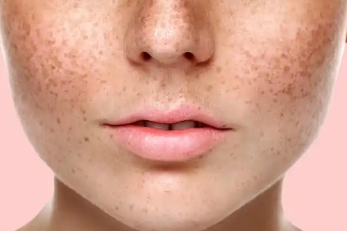 Боротьба з гіперпігментацією: причини та ефективні методи лікування Боротьба з гіперпігментацією: причини та ефективні методи лікування