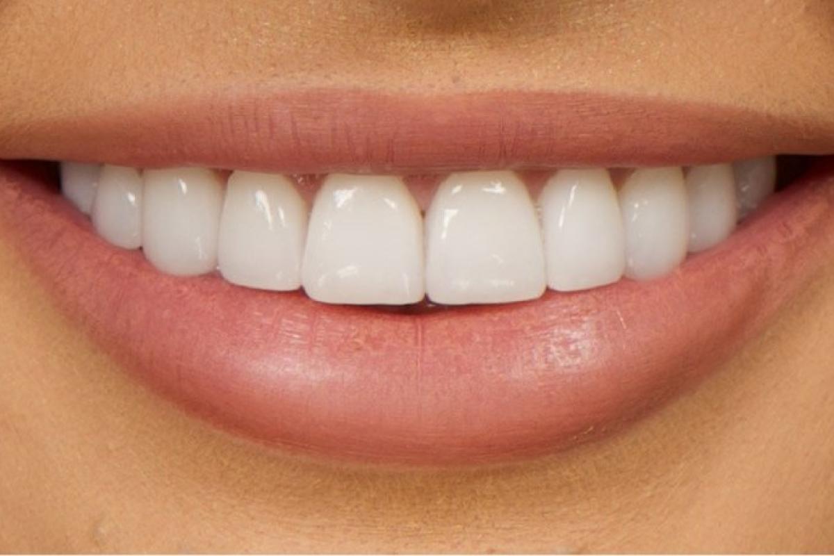 Сколько лет служат виниры