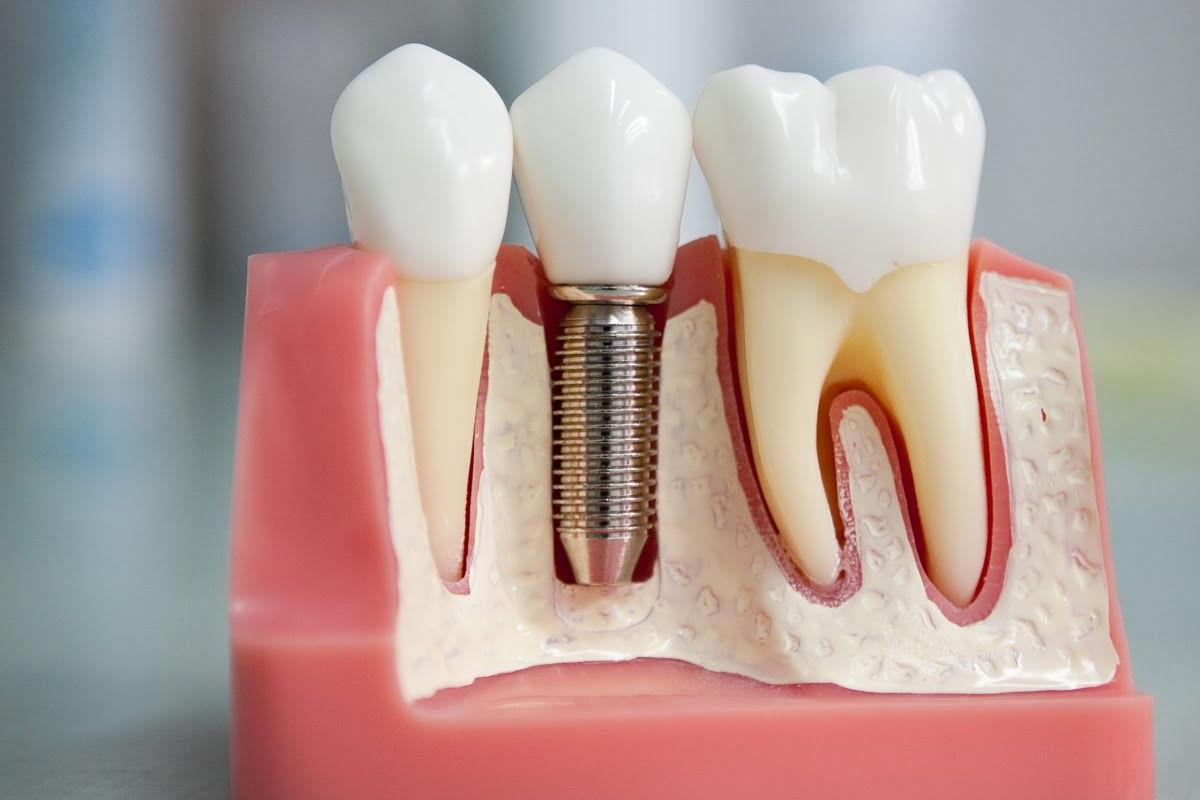 ціна імплантації зуба Львів