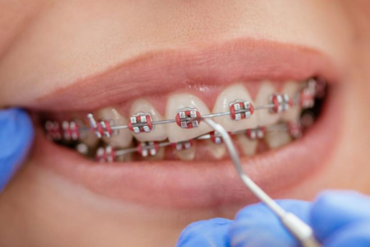 Кому категорически нельзя ставить брекеты и кому они нужны уже сейчас брекеты