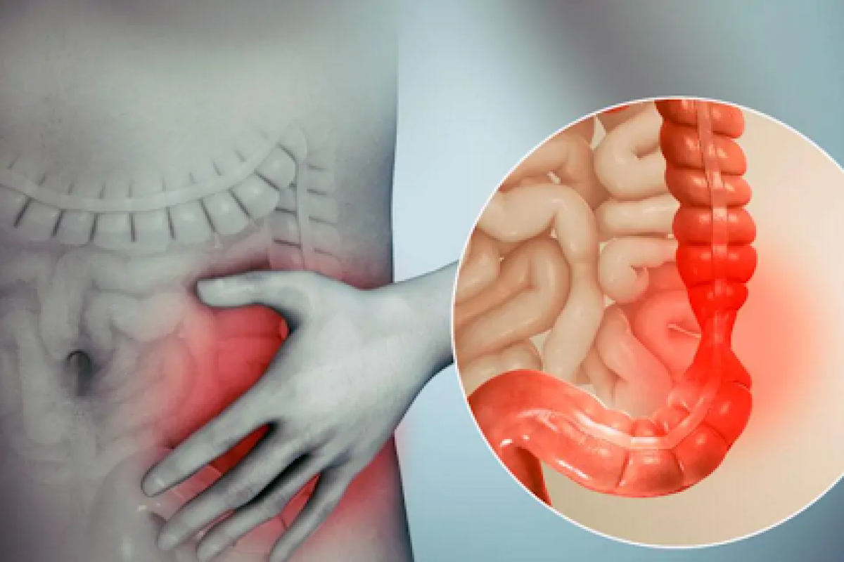 Синдром подразненого кишківника