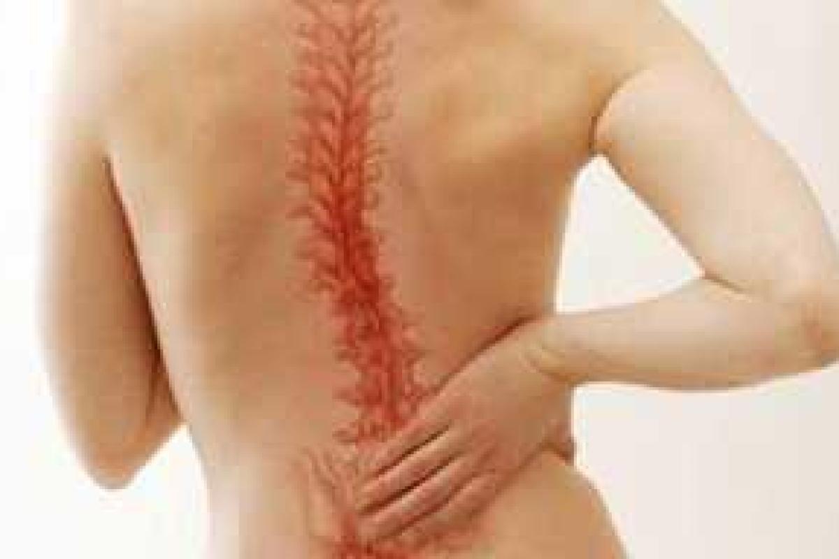 Сколиоз Сколиоз