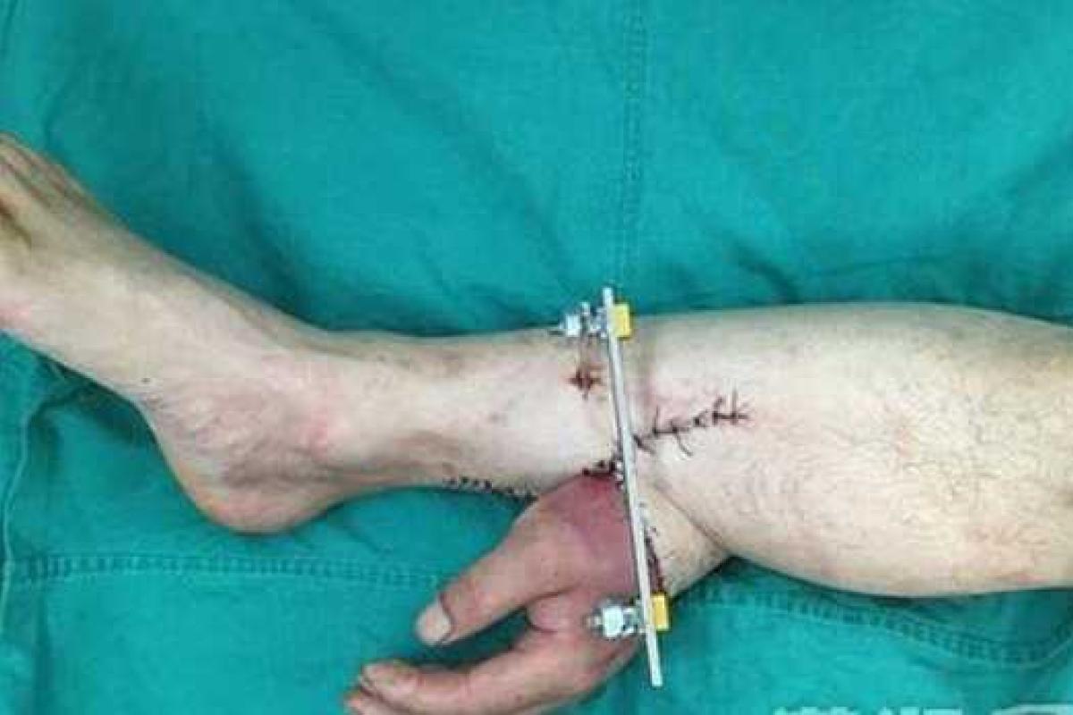 Китайские хирурги пришили руку пациента к его ноге Китайские хирурги пришили руку пациента к его ноге