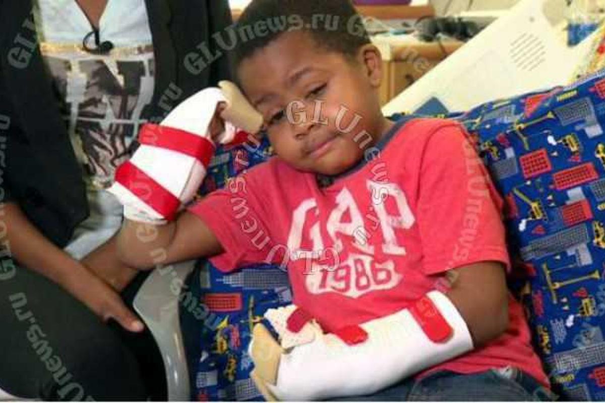 Американские врачи впервые в мире пересадили ребенку донорские руки Американские врачи впервые в мире пересадили ребенку донорские руки