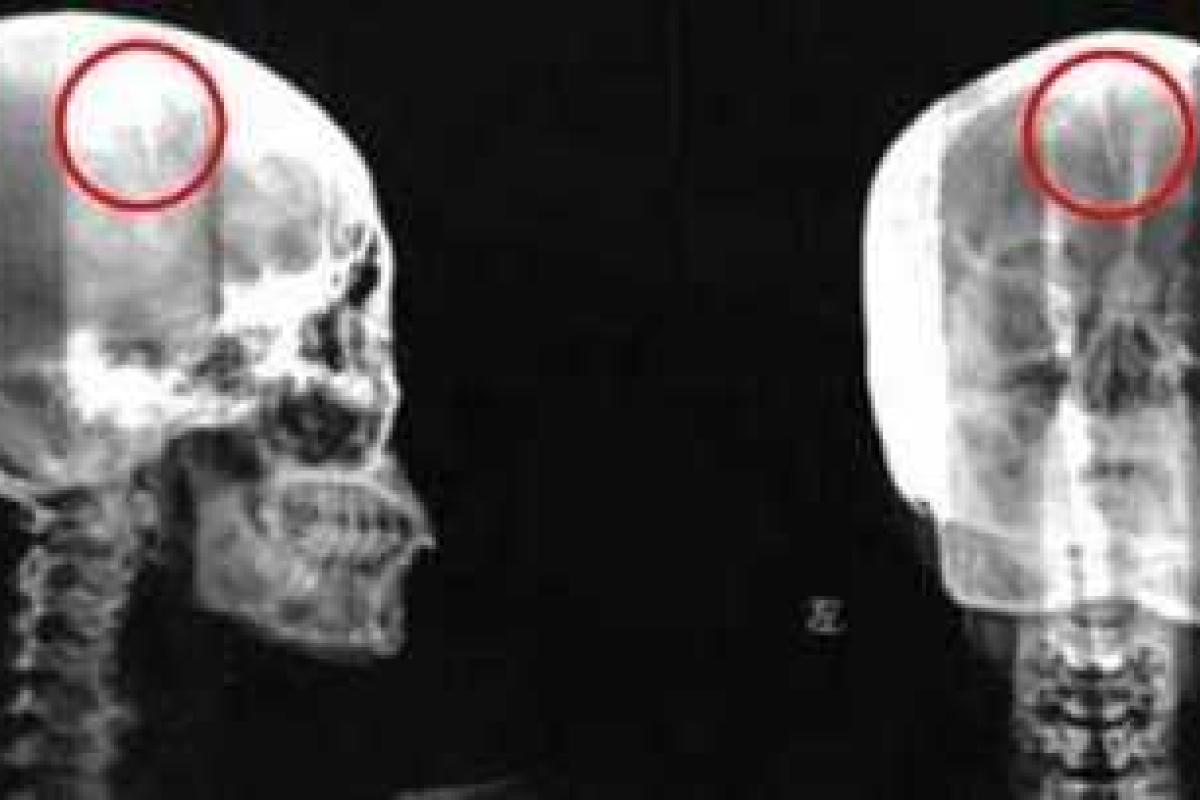 Китаянка прожила 46 лет с иглой в головном мозге