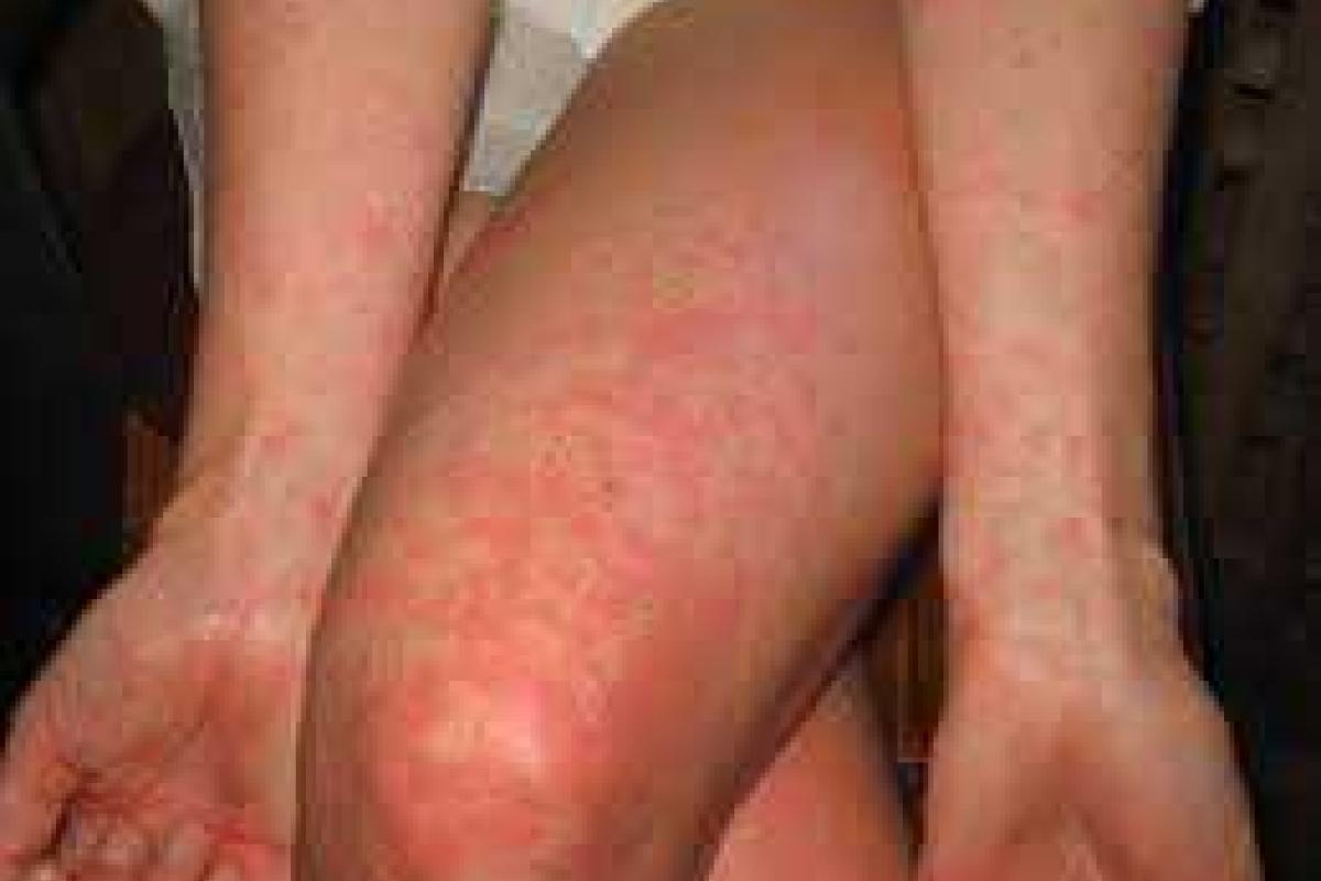 Киевлянка с лихорадкой Денге идет на поправку  Киевлянка с лихорадкой Денге идет на поправку