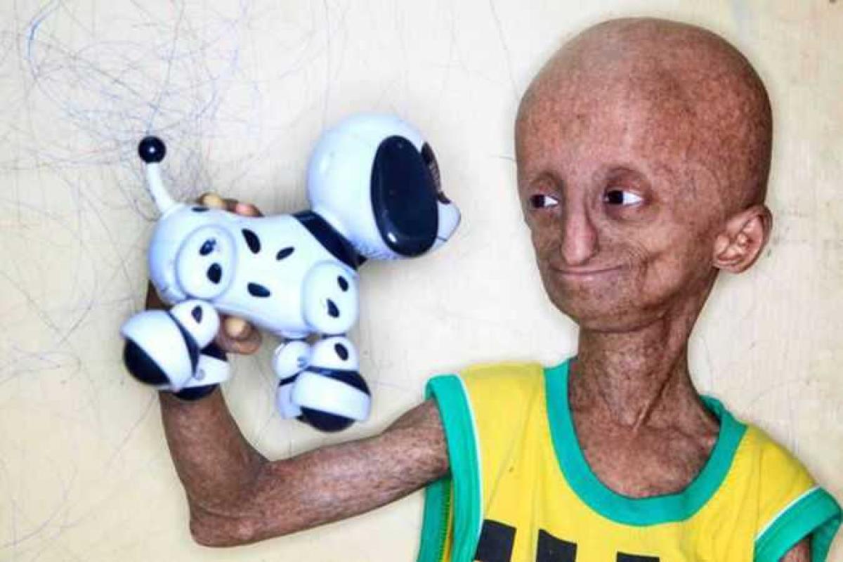 14-летний подросток из-за редкого заболевания похож на пришельца (18+) 14-летний подросток из-за редкого заболевания похож на пришельца (18+)