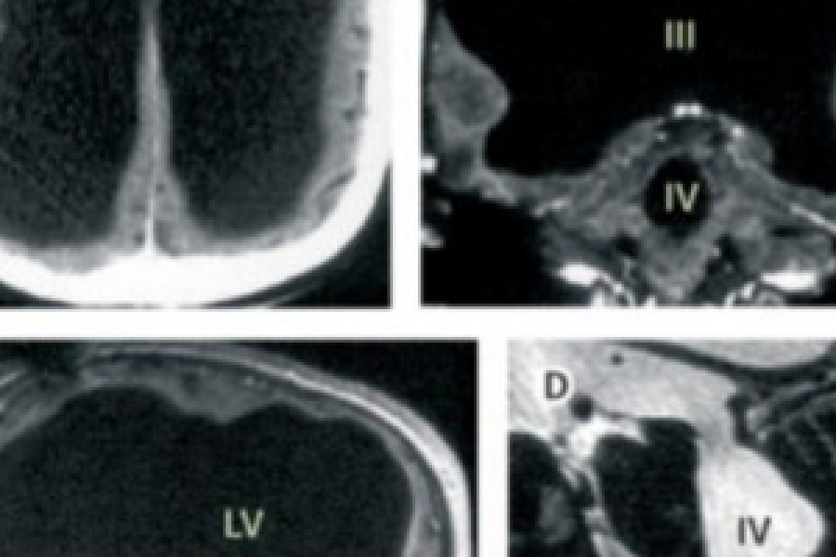 Во Франции живет мужчина без мозга