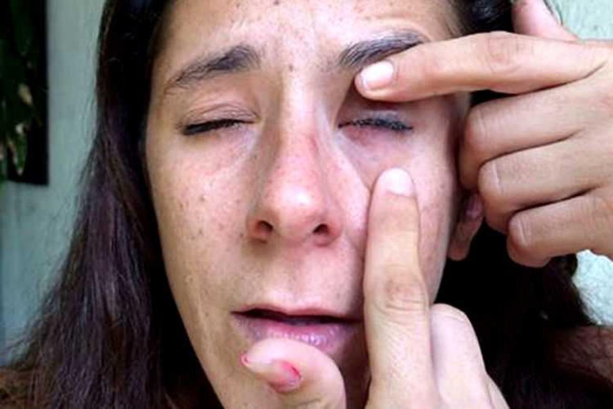 Женщине по ошибке закапали в глаза суперклей 