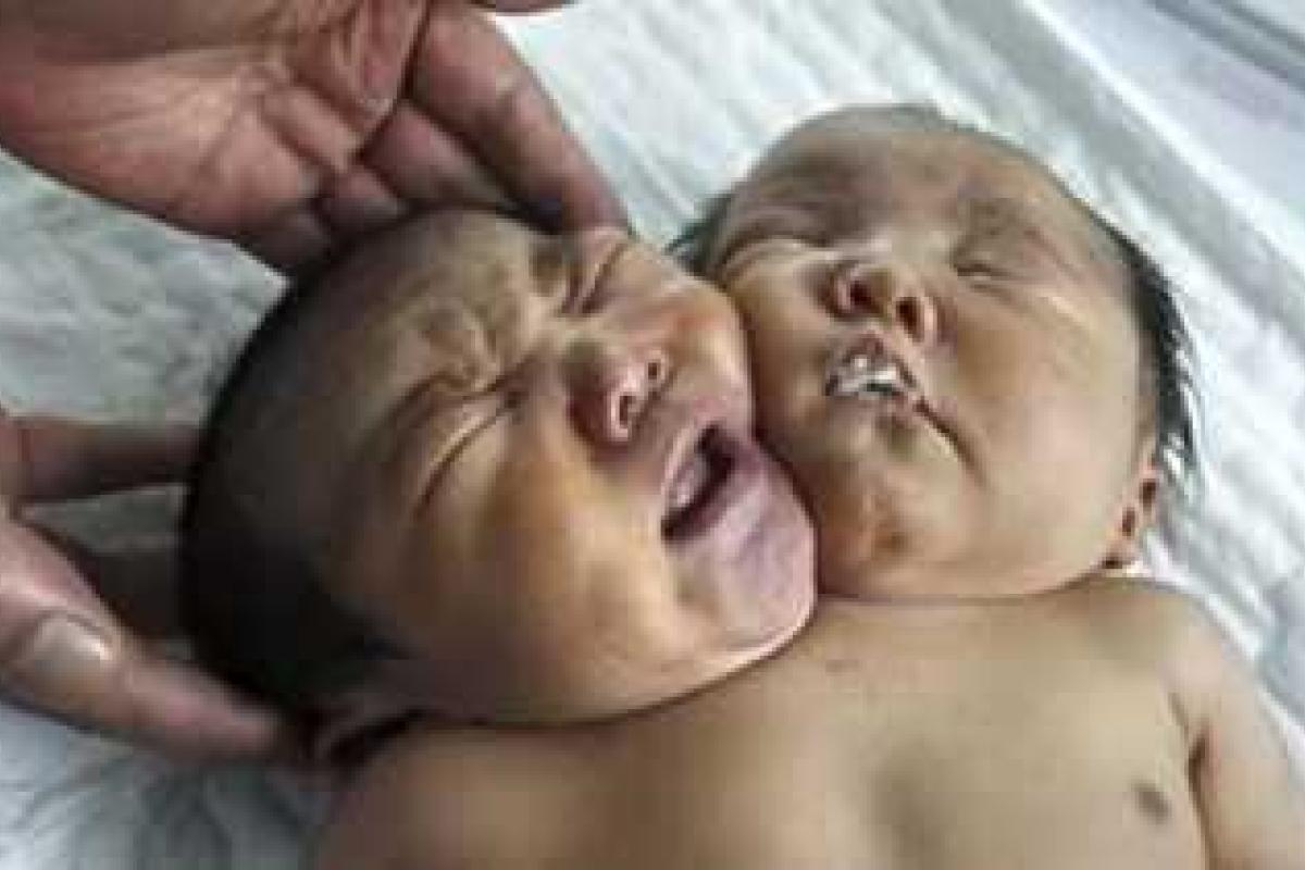 В Бангладеше родилась девочка-мутант с двумя головами