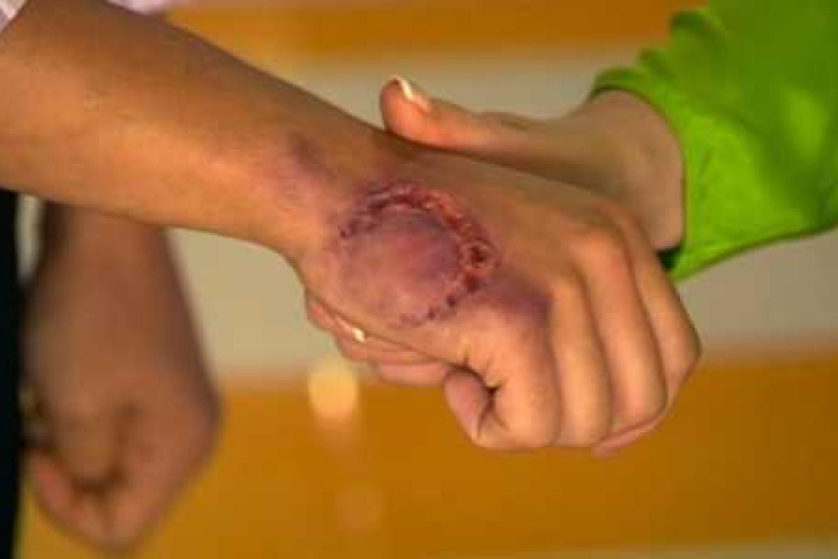 В «ДНР» паника: на людей нападают бешеные лисы