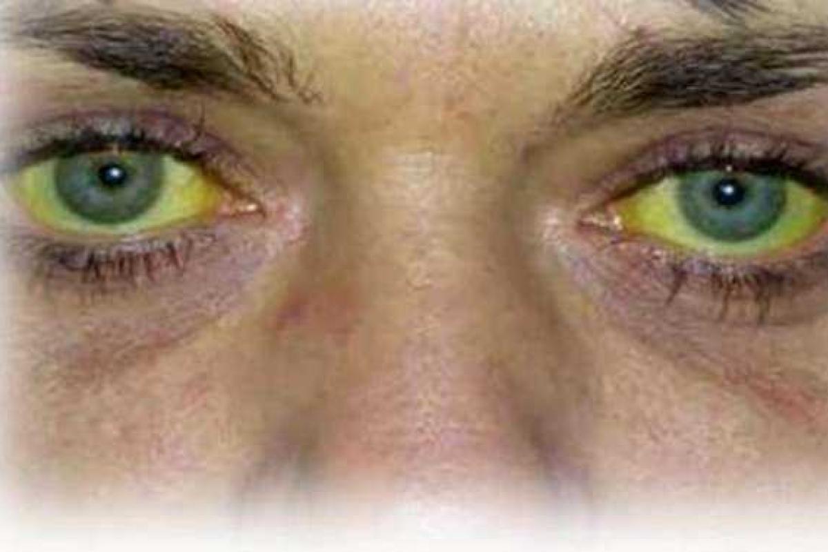 Российские наемники в Сирии массово заразились вирусным гепатитом Российские наемники в Сирии массово заразились вирусным гепатитом