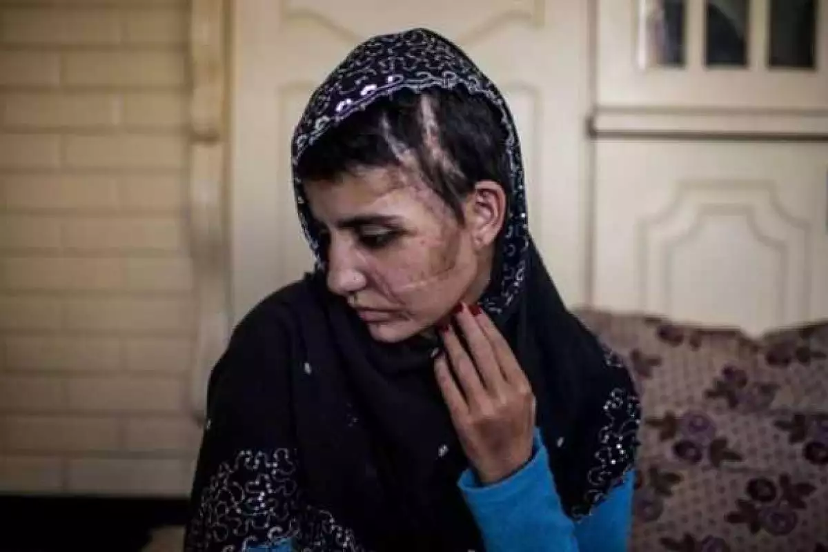 Пакистанка выжила после 15-ти ударов топором