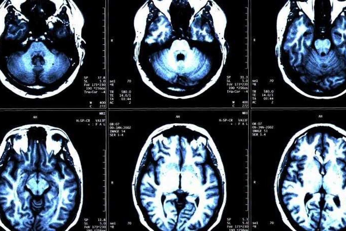 Француз потерял часть мозга и не заметил этого