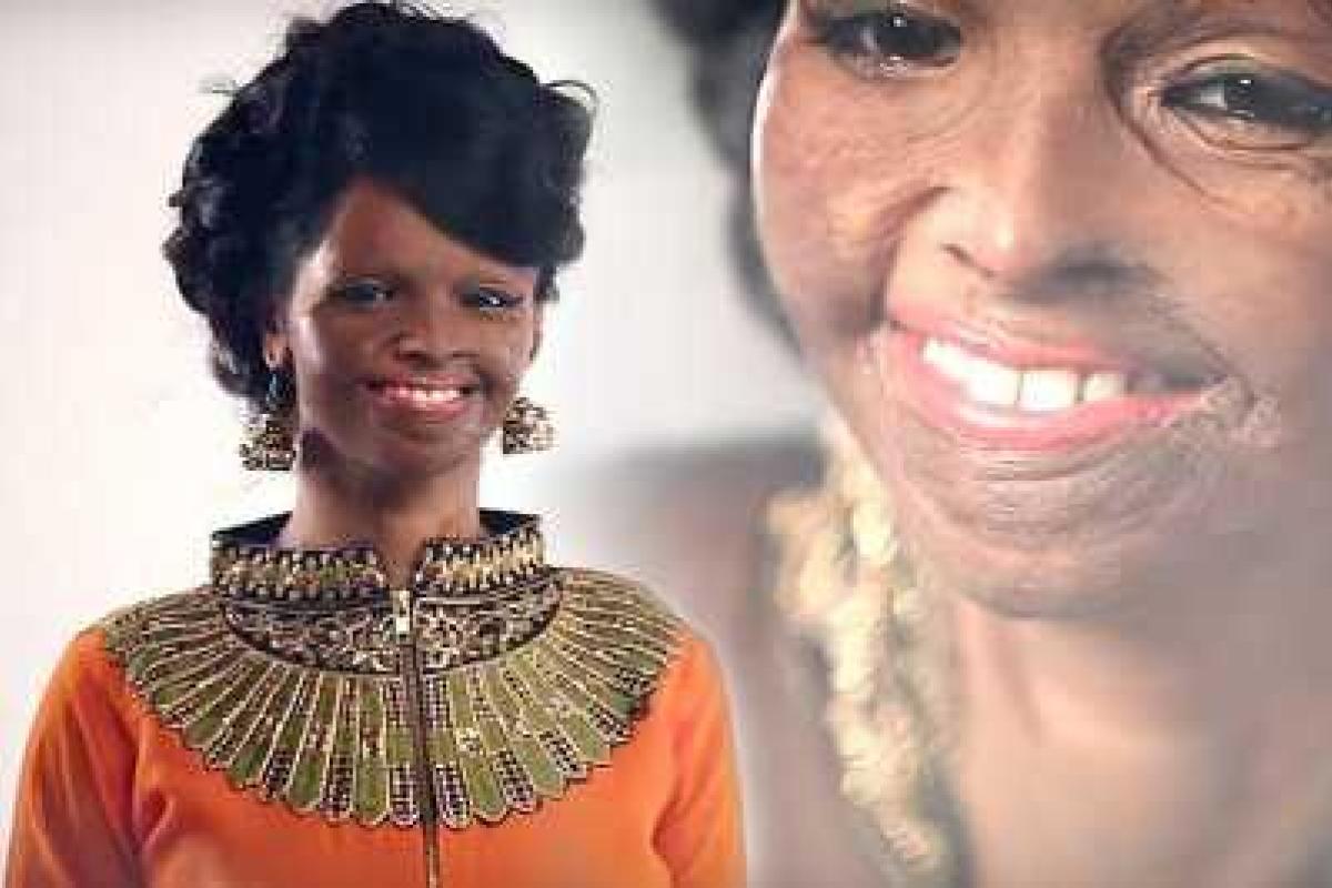 Лицом индийского бренда стала женщина, обожженная кислотой