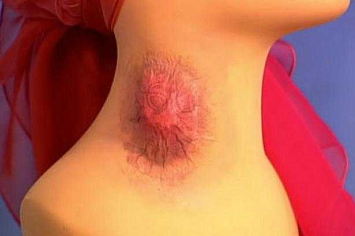 В Крыму впервые за 20 лет зарегистрирован случай опасного заболевания