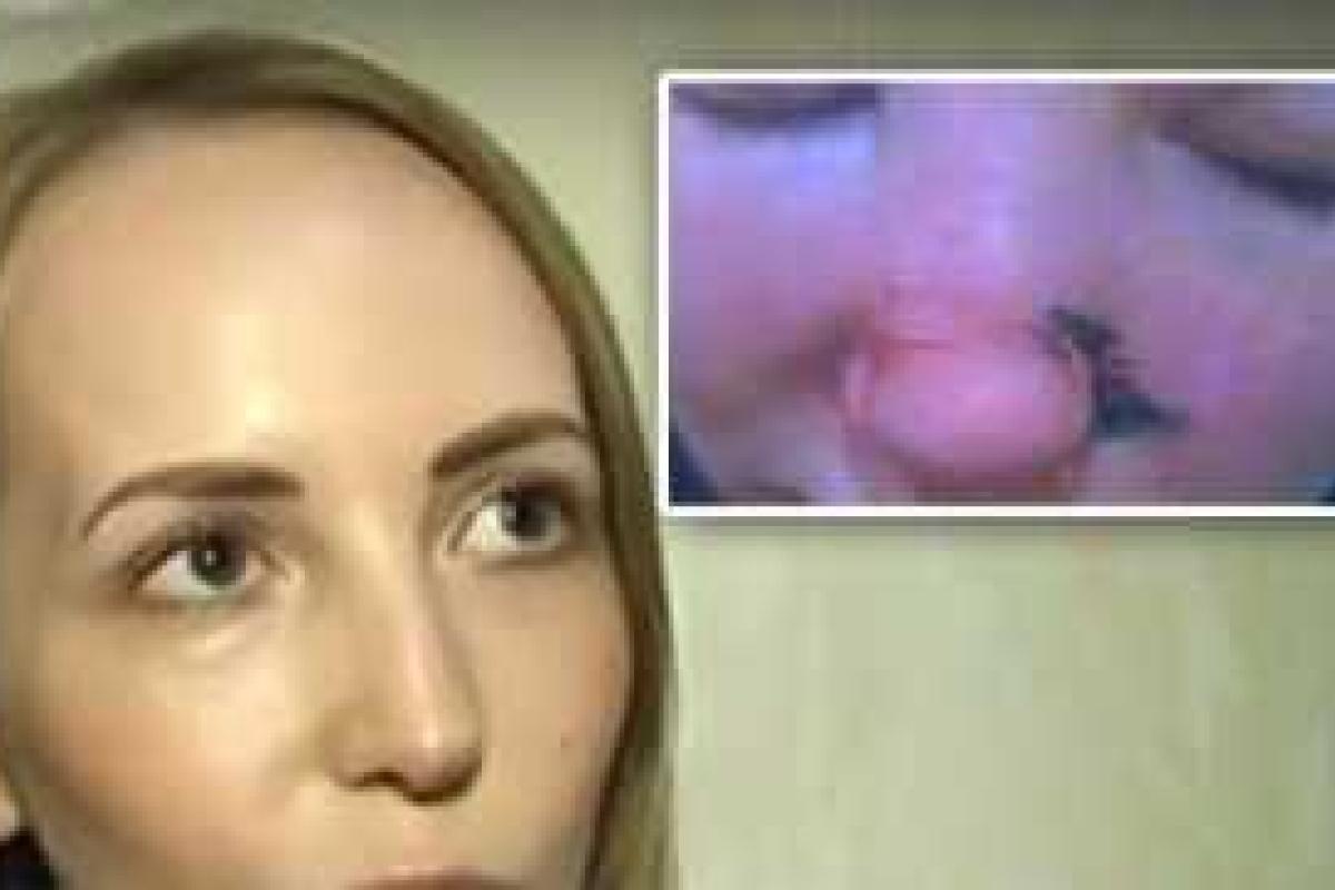 В России голый мужчина напал на бывшую жену и откусил ей нос