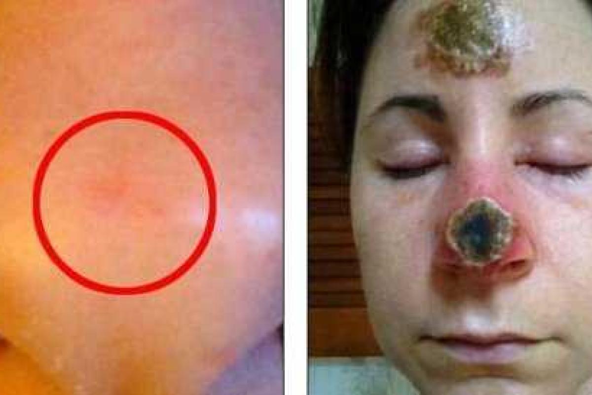 Женщина, которая лечила рак кожи народными средствами, осталась без носа